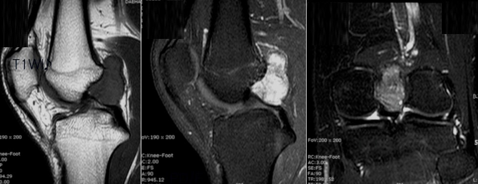 Figure 4 for case pigmented villonodular synovitis ( RID3641 )